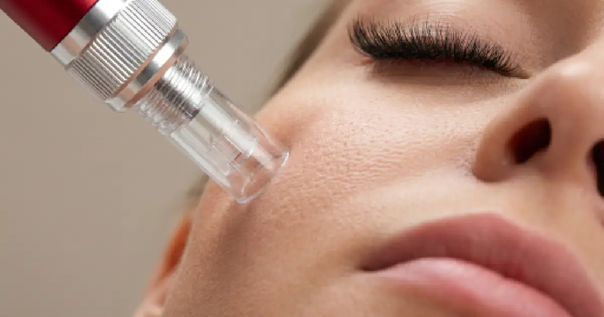 How Microneedling Helps with Acne Scars and Skin Texture
